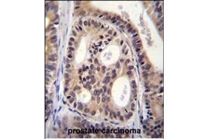 CYTSA Antibody (N-term) (ABIN656040 and ABIN2845411) immunohistochemistry analysis in formalin fixed and paraffin embedded human prostate carcinoma followed by peroxidase conjugation of the secondary antibody and DAB staining. (SPECC1L antibody  (N-Term))