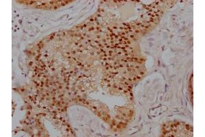 IHC image of ABIN7127775 diluted at 1:100 and staining in paraffin-embedded human prostate cancer performed on a Leica BondTM system. (Recombinant PRMT5 antibody)