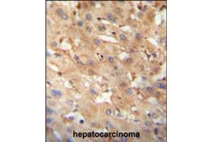NEU4 antibody immunohistochemistry analysis in formalin fixed and paraffin embedded human hepatocarcinoma followed by peroxidase conjugation of the secondary antibody and DAB staining. (Sialidase 4 antibody  (C-Term))