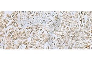 Immunohistochemistry of paraffin-embedded Human ovarian cancer tissue using FOXQ1 Polyclonal Antibody at dilution of 1:25(x200) (FOXQ1 antibody)