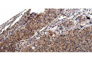 Immunohistochemistry of paraffin-embedded Human cervical cancer tissue using RAB41 Polyclonal Antibody at dilution 1:100 (RAB41 antibody)