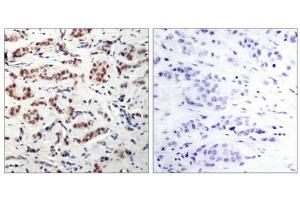Immunohistochemical analysis of paraffin-embedded human breast carcinoma tissue using STAT5A(Phospho-Tyr694) Antibody(left) or the same antibody preincubated with blocking peptide(right). (STAT5A antibody  (pTyr694))