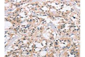 The image on the left is immunohistochemistry of paraffin-embedded Human thyroid cancer tissue using ABIN7190329(COL7A1 Antibody) at dilution 1/25, on the right is treated with synthetic peptide.