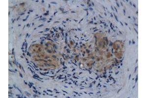 Formalin-fixed and paraffin embedded human colorectal cancer labeled with Anti-Anei-ATX/Autotaxin Polyclonal Antibody, Unconjugated (ABIN740265) followed by conjugation to the secondary antibody (ENPP2 antibody  (AA 601-700))