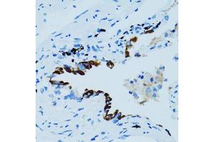 Immunohistochemistry of paraffin-embedded human lung cancer using CTSE antibody (ABIN5971444) at dilution of 1/100 (40x lens). (Cathepsin E antibody)