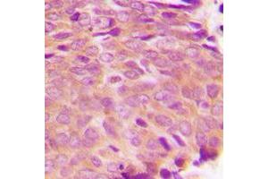 Immunohistochemical analysis of Transglutaminase 2 staining in human breast cancer formalin fixed paraffin embedded tissue section. (Transglutaminase 2 antibody  (N-Term))