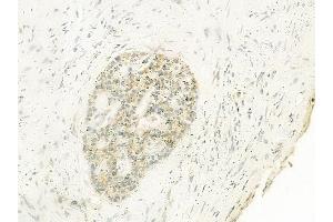 ABIN6262524 and ABIN6278481 at 1/100 staining human cervical carcinoma by IHC-P.
