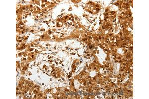 Immunohistochemistry of Human lung cancer using TENM3 Polyclonal Antibody at dilution of 1:50 (TENM3 antibody)