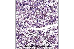 PROC Antibody (Center) (ABIN657466 and ABIN2846494) immunohistochemistry analysis in formalin fixed and paraffin embedded human hepatocarcinoma followed by peroxidase conjugation of the secondary antibody and DAB staining. (PROC antibody  (AA 177-206))