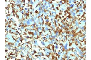 Formalin-fixed, paraffin-embedded human Histiocytoma stained with Factor XIIIa Mouse Monoclonal Antibody (F13A1/1448).