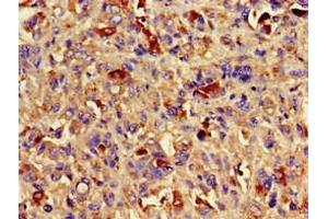 Immunohistochemistry of paraffin-embedded human melanoma using ABIN7145083 at dilution of 1:100 (Aurora Kinase C antibody  (AA 12-143))