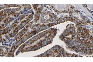 ABIN6267166 at 1/100 staining Human thyroid cancer tissue by IHC-P.