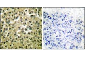 Immunohistochemistry analysis of paraffin-embedded human breast carcinoma tissue, using MCL1 Antibody. (MCL-1 antibody  (AA 91-140))
