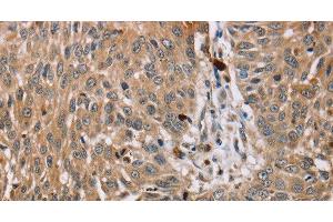 Immunohistochemistry of paraffin-embedded Human lung cancer tissue using PDLIM7 Polyclonal Antibody at dilution 1:35 (PDLIM7 antibody)