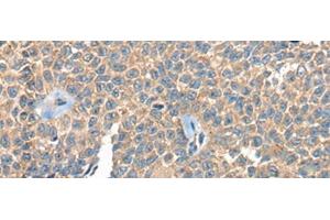 Immunohistochemistry of paraffin-embedded Human ovarian cancer tissue using PPP3R1 Polyclonal Antibody at dilution of 1:55(x200) (PPP3R1 antibody)