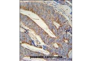 DACT1 antibody (N-term) (ABIN652102 and ABIN2840549) immunohistochemistry analysis in formalin fixed and paraffin embedded human prostate carcinoma followed by peroxidase conjugation of the secondary antibody and DAB staining. (DACT1 antibody  (N-Term))