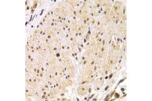 Immunohistochemistry of paraffin-embedded human stomach cancer using TMPRSS2 antibody (ABIN5975349) at dilution of 1/200 (40x lens). (TMPRSS2 antibody)