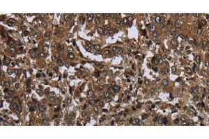Immunohistochemistry of paraffin-embedded Human liver cancer tissue using GLIPR1 Polyclonal Antibody at dilution 1:50