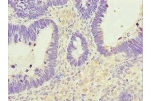 Immunohistochemistry of paraffin-embedded human ovarian cancer using ABIN7161949 at dilution of 1:100 (NUTF2 antibody  (AA 1-127))
