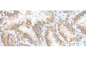 Immunohistochemistry of paraffin-embedded Human lung cancer tissue using RIDA Polyclonal Antibody at dilution of 1:65(x200)