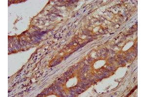 IHC image of ABIN7143628 diluted at 1:100 and staining in paraffin-embedded human colon cancer performed on a Leica BondTM system. (AARS antibody  (AA 164-321))