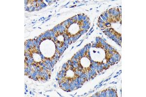 Immunohistochemistry of paraffin-embedded human colon carcinoma using Bax antibody (ABIN7265858) at dilution of 1:100 (40x lens). (BAX antibody)