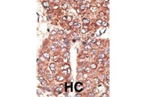 Formalin-fixed and paraffin-embedded human cancer tissue reacted with the primary antibody, which was peroxidase-conjugated to the secondary antibody, followed by AEC staining. (LRP2 antibody  (C-Term))