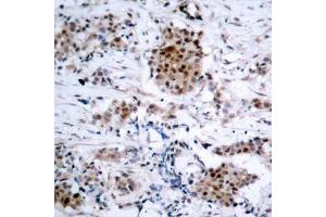 Immunohistochemistry of paraffin-embedded human breast carcinoma using Phospho-ESR1-S167 antibody (ABIN2988007). (Estrogen Receptor alpha antibody  (pSer167))
