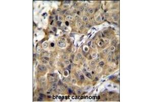 TME Antibody (C-term) (ABIN655659 and ABIN2845131) immunohistochemistry analysis in formalin fixed and paraffin embedded human breast carcinoma followed by peroxidase conjugation of the secondary antibody and DAB staining. (TMEM100 antibody  (C-Term))