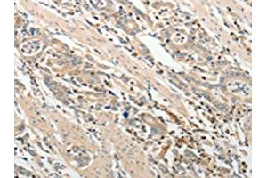 The image on the left is immunohistochemistry of paraffin-embedded Human gastric cancer tissue using ABIN7189660(ADAMTS2 Antibody) at dilution 1/25, on the right is treated with synthetic peptide. (Adamts2 antibody)