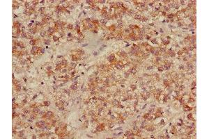 Immunohistochemistry of paraffin-embedded human liver cancer using ABIN7158499 at dilution of 1:100 (ACADL antibody  (AA 30-260))