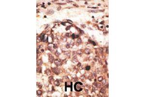 Formalin-fixed and paraffin-embedded human hepatocellular carcinoma tissue reacted with MMP8 polyclonal antibody  , which was peroxidase-conjugated to the secondary antibody, followed by AEC staining. (MMP8 antibody  (Internal Region))