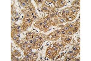 IHC analysis of FFPE human hepatocarcinoma tissue stained with ApoE antibody (APOE antibody  (AA 263-292))