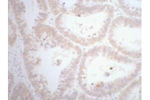 Immunohistochemistry (IHC) staining of human rectal cancer tissue, diluted at 1:200. (CDX2 antibody)
