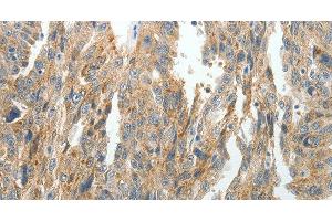 Immunohistochemistry of paraffin-embedded Human ovarian cancer tissue using PRDX5 Polyclonal Antibody at dilution 1:40 (Peroxiredoxin 5 antibody)