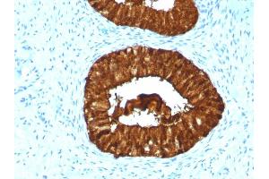 Formalin-fixed, paraffin-embedded human Cervical Carcinoma stained with MAML3 Monoclonal Antibody (MAML3/1303).