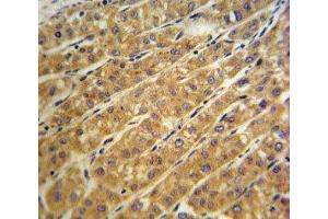CP antibody IHC analysis in formalin fixed and paraffin embedded human hepatocarcinoma. (Ceruloplasmin antibody  (AA 547-577))