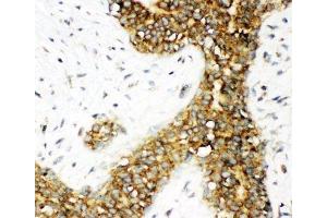 IHC-P: Calbindin antibody testing of human breast cancer tissue (CALB1 antibody  (AA 2-175))