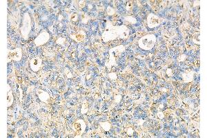 ABIN6257222 and ABIN6276028 at 1/100 staining Human liver cancer by IHC-P.