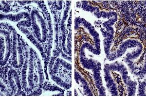 Paraffin embedded human gastric cancer tissue was stained with Goat IgG-UNLB isotype control, DAB, and hematoxylin. (Pig anti-Goat IgG (Heavy & Light Chain) Antibody)