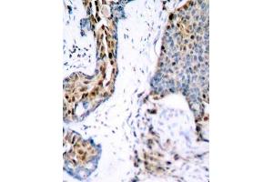 Immunohistochemistry of paraffin-embedded human breast carcinoma using Phospho-ESR1-S118 antibody (ABIN2987431). (Estrogen Receptor alpha antibody  (pSer118))