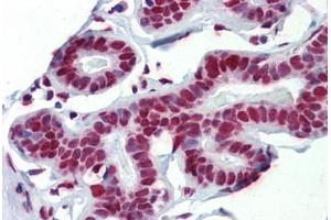 Human Breast (formalin-fixed, paraffin-embedded) stained with FUS antibody ABIN462224 followed by biotinylated goat anti-rabbit IgG secondary antibody ABIN481713, alkaline phosphatase-streptavidin and chromogen. (FUS antibody  (N-Term))
