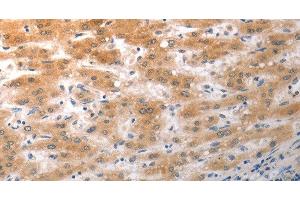 Immunohistochemistry of paraffin-embedded Human liver cancer using NQO2 Polyclonal Antibody at dilution of 1:50 (NQO2 antibody)