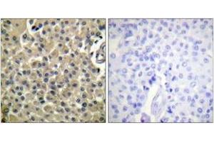 Immunohistochemistry analysis of paraffin-embedded human breast carcinoma tissue, using CD227/Mucin 1 (Ab-1243) Antibody. (MUC1 antibody  (AA 1204-1253))