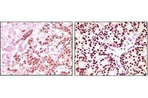 Immunohistochemical analysis of paraffin-embedded human breast carcinoma, using ER-alpha antibody showing nuclear expression with DAB staining. (Estrogen Receptor alpha antibody  (AA 410-592))