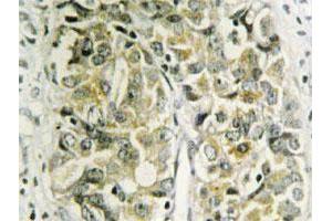 Immunohistochemical analysis of paraffin-embedded human prostate cancer tissue using LGALS8 polyclonal antibody .