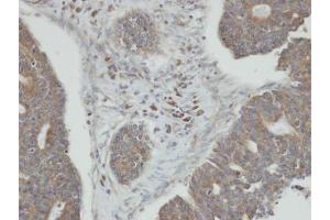 IHC-P Image Immunohistochemical analysis of paraffin-embedded human endo mitral ovarian cancer, using PPM1K, antibody at 1:100 dilution. (PPM1K antibody)
