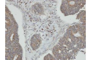 IHC-P Image Immunohistochemical analysis of paraffin-embedded human endo mitral ovarian cancer, using PPM1K, antibody at 1:100 dilution. (PPM1K antibody)
