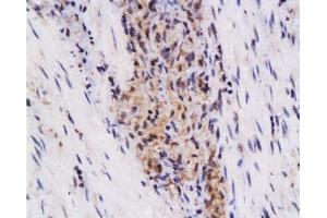 Formalin-fixed and paraffin embedded human colon carcinoma labeled with Anti-SynCAM/TSLC1 Polyclonal Antibody, Unconjugated  at 1:200 followed by conjugation to the secondary antibody and DAB staining. (CADM1 antibody  (AA 365-442))