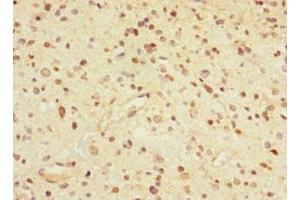 Immunohistochemistry of paraffin-embedded human glioma using ABIN7153488 at dilution of 1:100 (GABRA5 antibody  (AA 32-259))